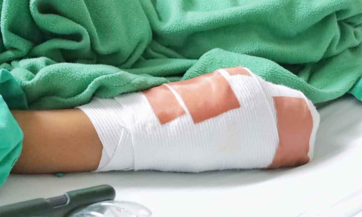 Icbf anuncia sanciones a padres de menores quemados con pólvora