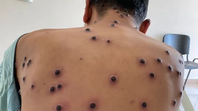 No hay casos, pero se prenden las alarmas