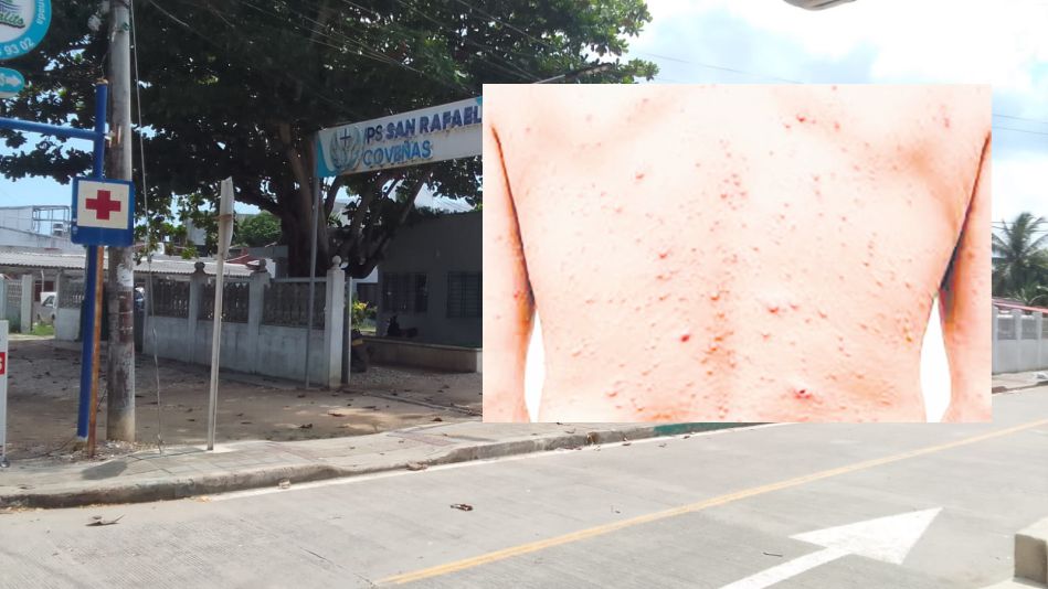 Refuerzan la vigilancia epidemiológica ante la viruela del mono o símica