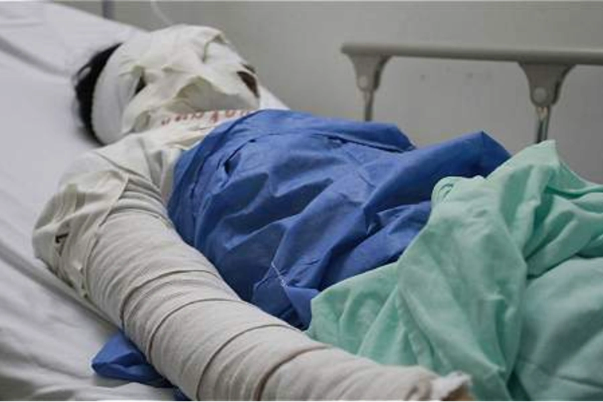 Murió por graves quemaduras
